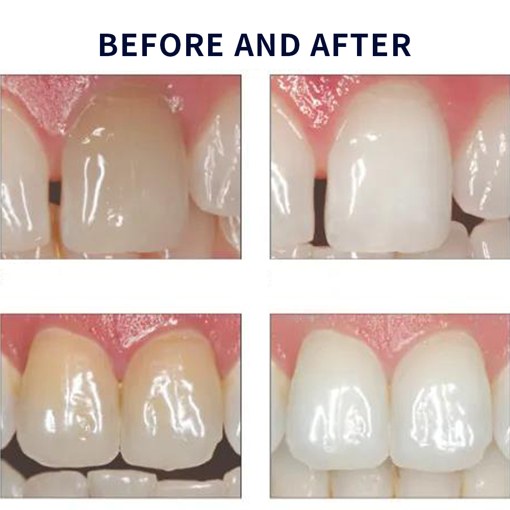 Opalescence Whitening 20% PF 2 - Teeth Whitening Price recension och pris