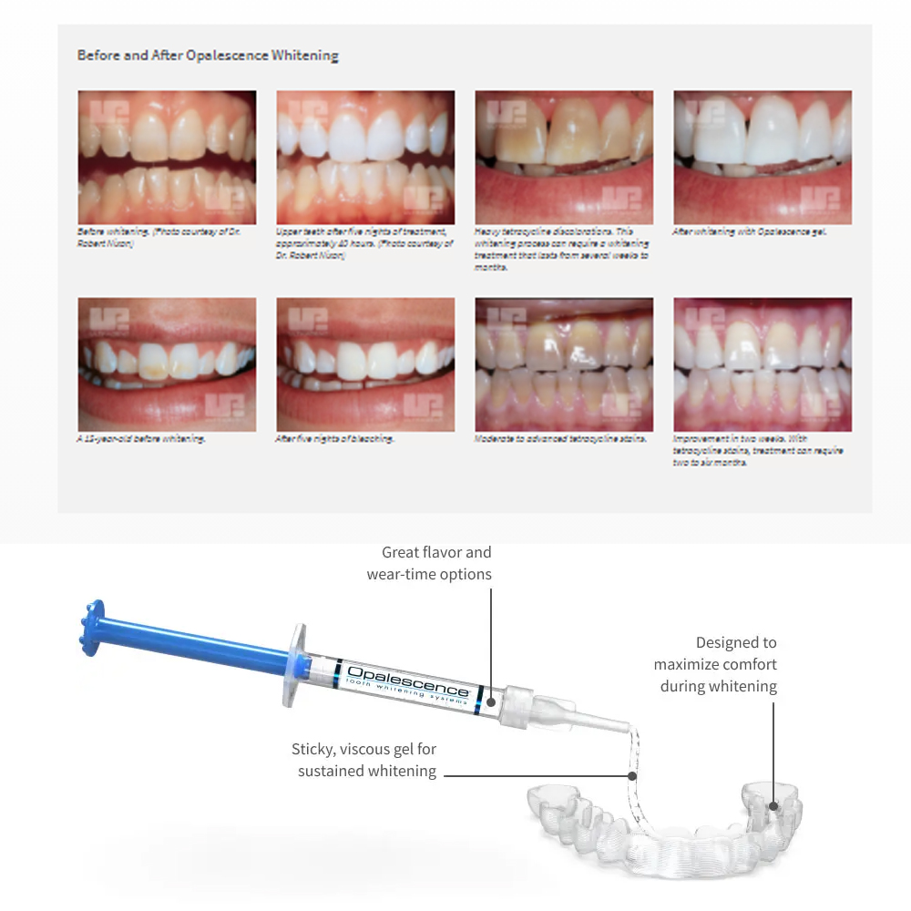 Opalescence Whitening 20% PF 2 - Teeth Whitening Price recension och pris