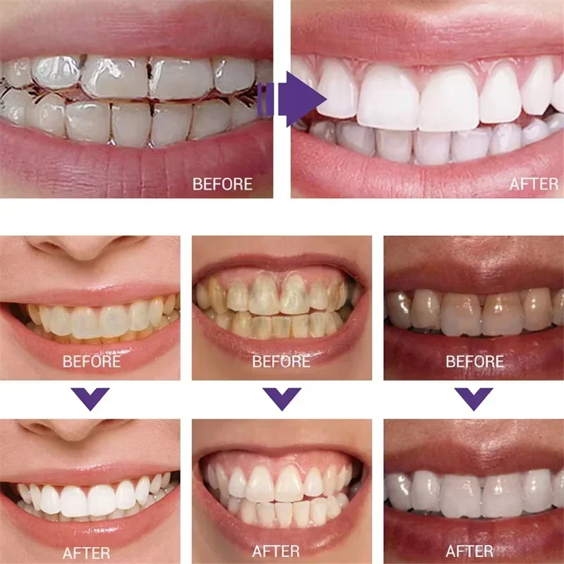 Teeth Cleansing Whitening Toot - Teeth Whitening In Korea recension och pris