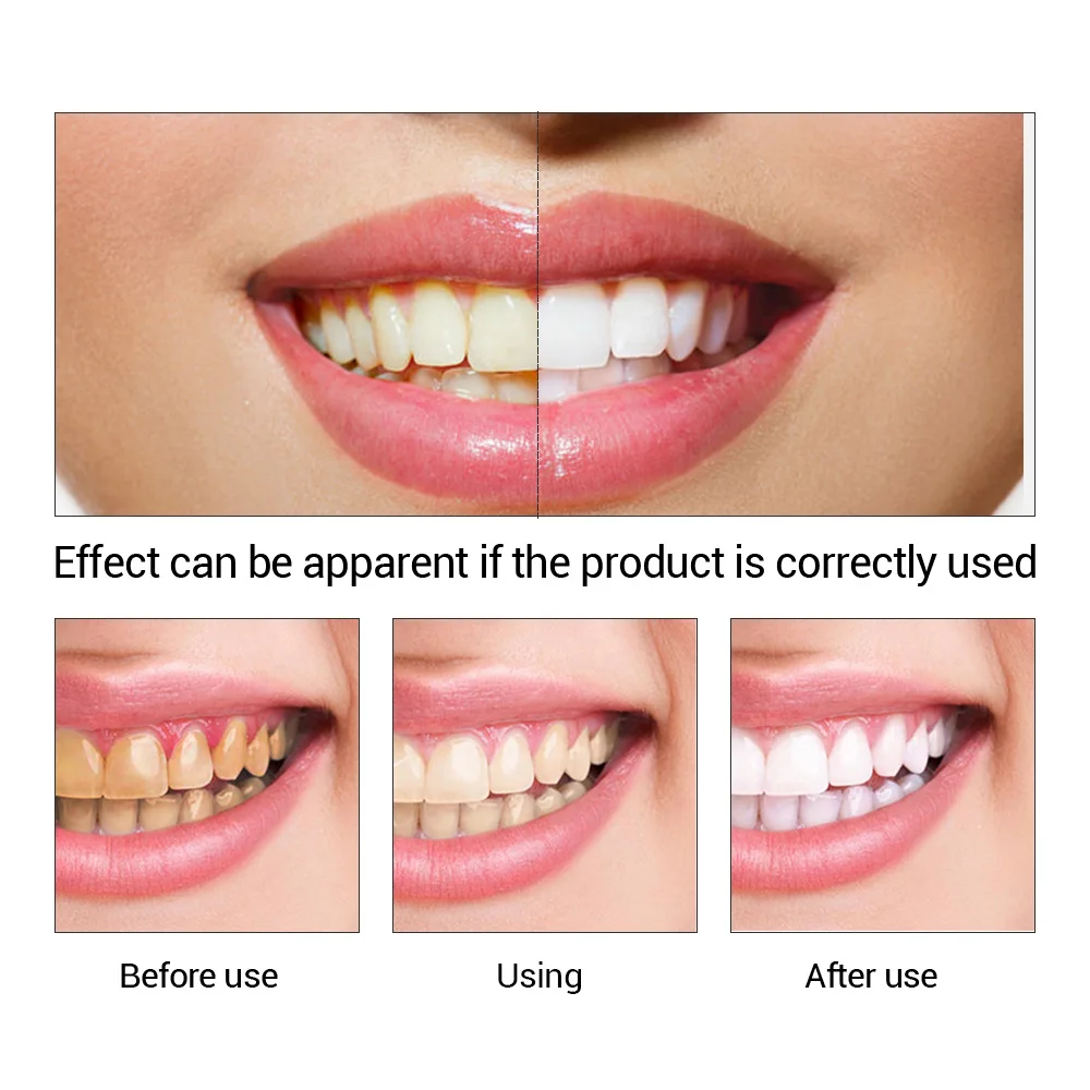 FTEENPLY Teeth Whitening Essen - Teeth Whitening Price recension och pris