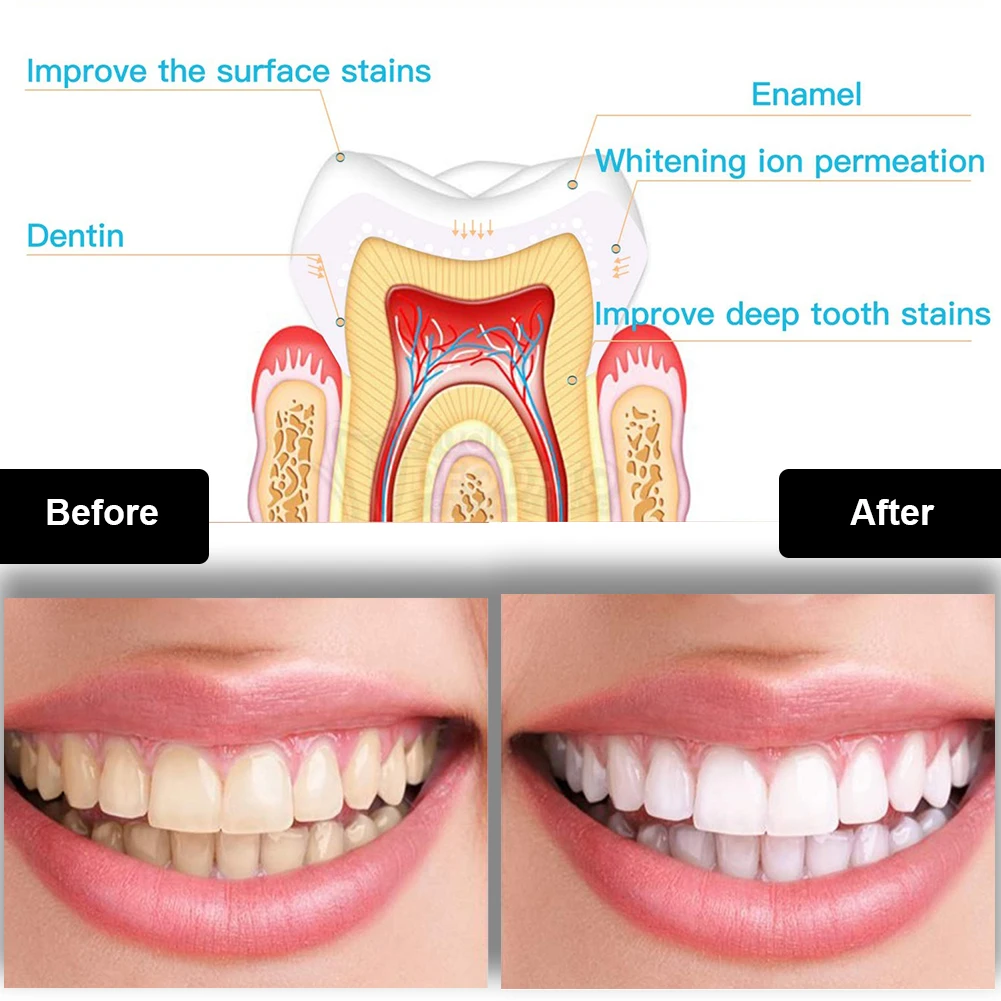 Dental Teeth Whitening Kit Min - Teeth Whitening Price recension och pris